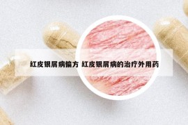 紅皮銀屑病偏方 紅皮銀屑病的治療外用藥