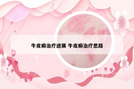牛皮癬治療進(jìn)展 牛皮癬治療思路