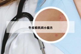 牛皮癬民間小偏方