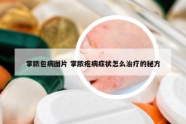 掌膿包病圖片 掌膿皰病癥狀怎么治療的秘方