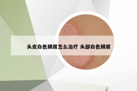 頭皮白色鱗屑怎么治療 頭部白色鱗屑