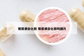 銀屑病會(huì)化膿 銀屑病會(huì)化膿嗎圖片