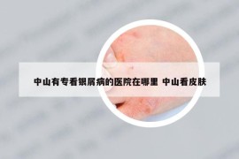 中山有專看銀屑病的醫(yī)院在哪里 中山看皮膚