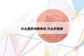 什么西藥對(duì)癬有效 什么藥管癬