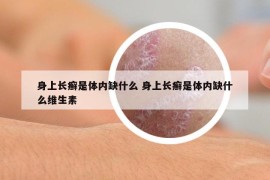 身上長癬是體內(nèi)缺什么 身上長癬是體內(nèi)缺什么維生素