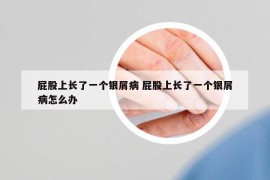 屁股上長了一個銀屑病 屁股上長了一個銀屑病怎么辦