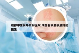 成都哪里有牛皮癬醫(yī)院 成都看銀屑病最好的醫(yī)生