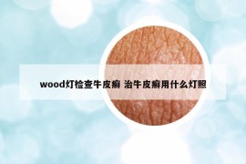 wood燈檢查牛皮癬 治牛皮癬用什么燈照