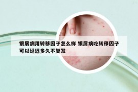 銀屑病用轉(zhuǎn)移因子怎么樣 銀屑病吃轉(zhuǎn)移因子可以延遲多久不復(fù)發(fā)
