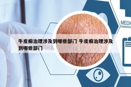 牛皮癬治理涉及到哪些部門(mén) 牛皮癬治理涉及到哪些部門(mén)