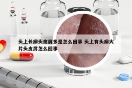 頭上長(zhǎng)癬頭皮屑多是怎么回事 頭上有頭癬大片頭皮屑怎么回事