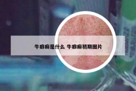 牛癖癬是什么 牛癖癬初期圖片