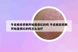 牛皮癬皮疹剛開始是很紅的嗎 牛皮癬皮疹剛開始是很紅的嗎怎么治療