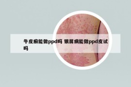 牛皮癬能做ppd嗎 銀屑病能做ppd皮試嗎