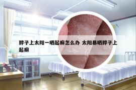 脖子上太陽(yáng)一曬起癬怎么辦 太陽(yáng)暴曬脖子上起癬