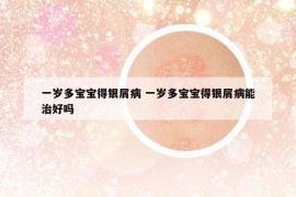 一歲多寶寶得銀屑病 一歲多寶寶得銀屑病能治好嗎
