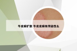 牛皮癬擴散 牛皮皮癬有傳染性么