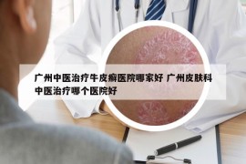 廣州中醫(yī)治療牛皮癬醫(yī)院哪家好 廣州皮膚科中醫(yī)治療哪個(gè)醫(yī)院好