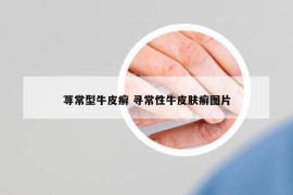 蕁常型牛皮癬 尋常性牛皮膚癬圖片