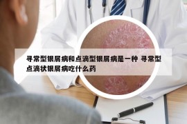 尋常型銀屑病和點滴型銀屑病是一種 尋常型點滴狀銀屑病吃什么藥
