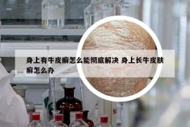 身上有牛皮癬怎么能徹底解決 身上長(zhǎng)牛皮膚癬怎么辦