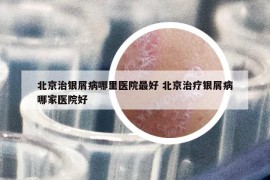 北京治銀屑病哪里醫(yī)院最好 北京治療銀屑病哪家醫(yī)院好