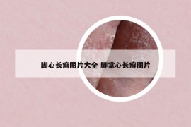 腳心長(zhǎng)癬圖片大全 腳掌心長(zhǎng)癬圖片