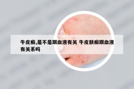 牛皮癬,是不是跟血液有關(guān) 牛皮膚癬跟血液有關(guān)系嗎