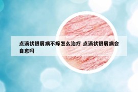點(diǎn)滴狀銀屑病不癢怎么治療 點(diǎn)滴狀銀屑病會(huì)自愈嗎