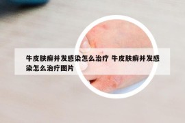 牛皮膚癬并發(fā)感染怎么治療 牛皮膚癬并發(fā)感染怎么治療圖片