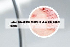 小手術能導致銀屑病爆發(fā)嗎 小手術后會出現(xiàn)銀屑病