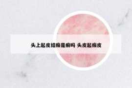 頭上起皮結(jié)痂是癬嗎 頭皮起痂皮