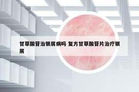 甘草酸苷治銀屑病嗎 復(fù)方甘草酸苷片治療銀屑