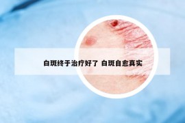 白斑終于治療好了 白斑自愈真實(shí)