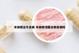 羊蹄根冶牛皮癬 羊蹄根泡醋治銀屑病嗎