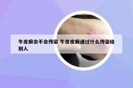 牛皮癬會(huì)不會(huì)傳染 牛皮皮癬通過什么傳染給別人