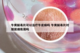 牛黃解毒片可以治療牛皮癬嗎 牛黃解毒片對銀屑病有用嗎