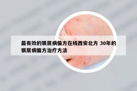 最有效的銀屑病偏方在線西安北方 30年的銀屑病偏方治療方法