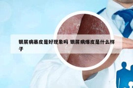 銀屑病暴皮是好現(xiàn)象嗎 銀屑病爆皮是什么樣子