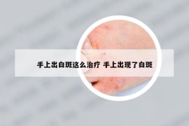 手上出白斑這么治療 手上出現(xiàn)了白斑