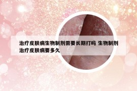 治療皮膚病生物制劑需要長期打嗎 生物制劑治療皮膚病要多久