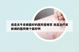 南昌去牛皮癬最好的醫(yī)院是哪家 南昌治療皮膚病的醫(yī)院哪個(gè)最好啊