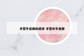 手臂牛皮癬的癥狀 手臂長(zhǎng)牛皮鮮