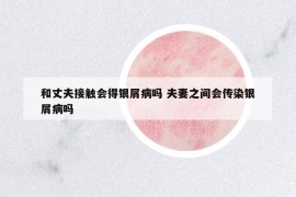 和丈夫接觸會(huì)得銀屑病嗎 夫妻之間會(huì)傳染銀屑病嗎