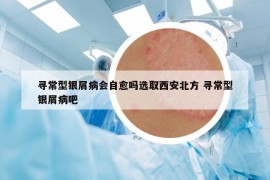 尋常型銀屑病會自愈嗎選取西安北方 尋常型銀屑病吧