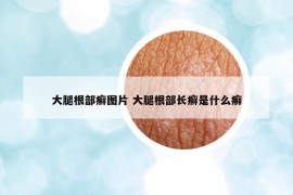 大腿根部癬圖片 大腿根部長(zhǎng)癬是什么癬