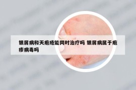銀屑病和天皰瘡能同時(shí)治療嗎 銀屑病屬于皰疹病毒嗎