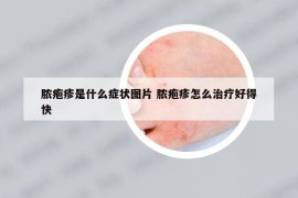 膿皰疹是什么癥狀圖片 膿皰疹怎么治療好得快