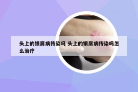 頭上的銀屑病傳染嗎 頭上的銀屑病傳染嗎怎么治療