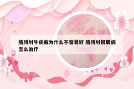 胳膊肘牛皮癬為什么不容易好 胳膊肘銀屑病怎么治療